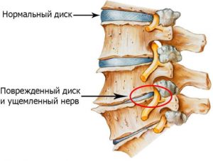 hondroz-osteoh-razn-2